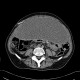 Peritoneal dialysis, complication, fluid collection, gigantic, after: CT - Computed tomography